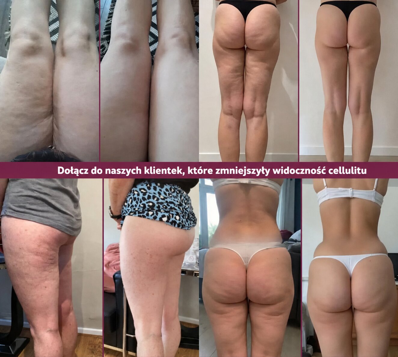 fitUp Legginsy 3D – Zmniejsz widoczność cellulitu i ciesz się gładszą sylwetką